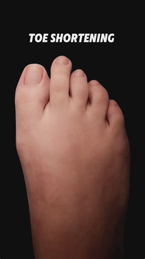 Luxe Foot Surgery | 💉 Treatment: Minimally Invasive Toe Shortening Surgery 🤓 How it works: Bottom incision with cosmetic closure 🌟 Results: Immediate... | Instagram
