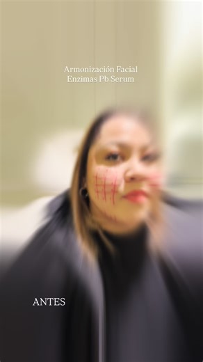 Sublime | Método Sublime ®️ on Instagram: "Armonización Facial con Enzimas PB Serum® – 1 sesión En esta paciente realizamos armonización facial mediante enzimas PB Serum®, un tratamiento biológico avanzado enfocado en la reducción de adiposidad localizada, mejora del contorno facial y optimización de la calidad de la piel. 🔬 Resultados observados tras 1 sesión: • Disminución visible de volumen en mejillas • Definición del óvalo facial • Mejora en la textura y luminosidad de la piel • Aspecto má