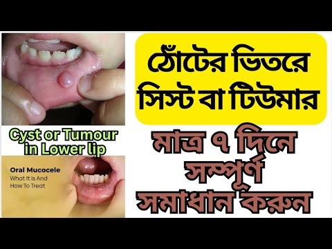 What are the causes of cyst or tumor under the lip and how to solve it? Cyst/Tumour in under of l...