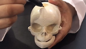 Fetal Skull