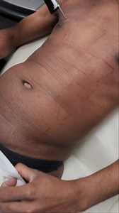 Professional Laser Hair Removal * Chest & Abs * Video #82 - Simply click on the hashtag #velvetlaserhairremoval to see all our videos of Laser Hair Removal - Queens, NY #1 Choice for Laser Hair Removal - We treat all Body Hair, except eyelids - Our Lasers target the hair at the root - This is 1 of 6 Lasers we have on the premises - Laser is one of our Specialties - We Provide safe and effective Laser Hair Removal treatments on all skin types, Since 2009 - 6 FDA approved Medical Lasers on the pre