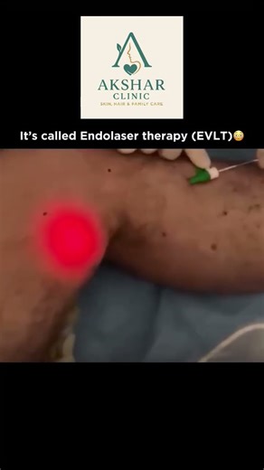 Endolaser therapy #varicoseveins #science #medico #subscribe #humananatomy #share #biology #medicine