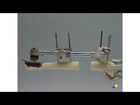 Monolateral External Fixation System for Trauma and Orthopaedics (MEFISTO)