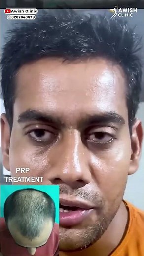 Amazing PRP Hair Loss Treatment Before and After Results | How Does PRP Work l AWISH Clinic