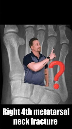 4th metatarsal neck fracture
