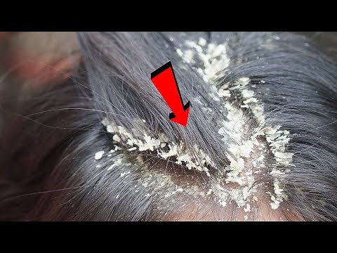 Satisfying Extremely Damaged Dandruff Removal #1013