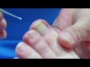 Involuted Toenails