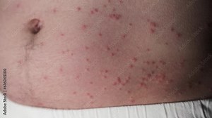Summertime Rashes - Pimples on the body, stomach. Possible insect bites, allergic reaction. Severe itching. Closeup of man's belly.