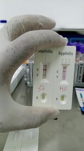 Todo sobre la Prueba de Sífilis Positiva