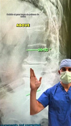 L2–Pelvis Fusion 🧵🧠 This patient had a remote thoracic fracture that altered his biomechanics for