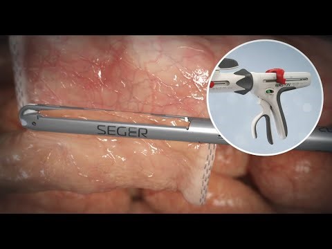 Seger Surgical - IDEA Stapling System | Medical Animations