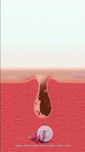 How to clean skin pores device demonstration | Skin cleaning device | 3d medical animation