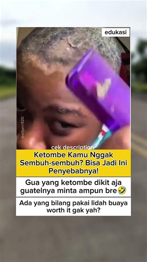 Ketombe Kamu Nggak Sembuh-sembuh? Bisa Jadi Ini Penyebabnya