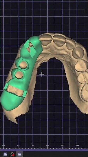 guia cirúrgico exocad CAD Cam