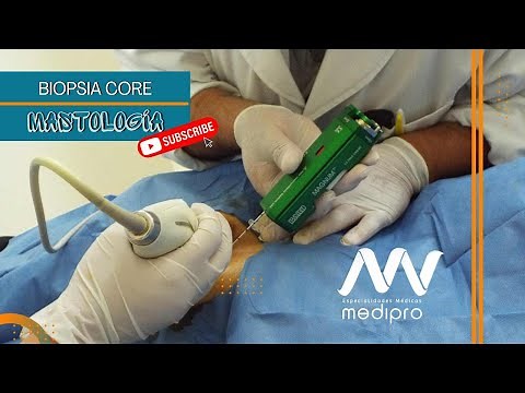EP 53 - CORE breast biopsy! - How is it done?
