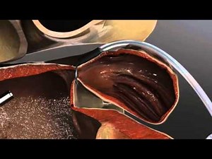 Left Atrial Appendage Exclusion Animation