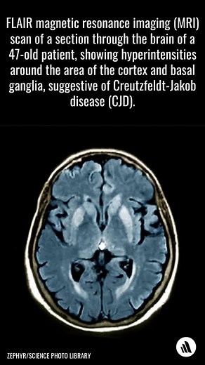 Creutzfeldt-Jakob disease (CJD) is the most common human prion disease. It occurs worldwide and has several forms and subtypes. Symptoms include dementia, myoclonus, and other central nervous system deficits. Treatment is supportive. Refresh your knowledge: https://mrkmnls.co/4jbX9k5 | Merck Manual Professional