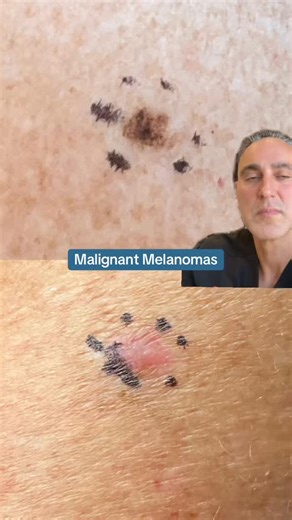 Malignant Melanomas Believe it or not, both lesions shown here are biopsy-proven malignant melanomas. The top lesion is a classic melanoma with the typical characteristics of being an atypical, pigmented lesion, containing various shades of brown and black with irregular borders. On the other hand, the bottom photo depicts a rarer type of melanoma, called an amelanotic melanoma, which unfortunately often goes undiagnosed. Both lesions happen to be equally deadly. Remember, the best cure for mali