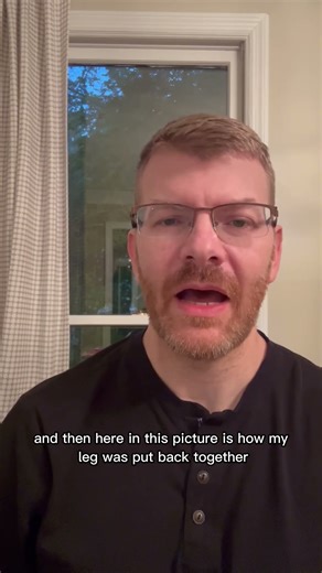 X-Ray of my broken leg and how surgeon put it back together.