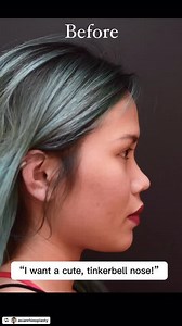 Asian Blepharoplasty with Ptosis Repair and Asian Rhinoplasty