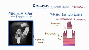 Video: Hirschsprung disease - Video Explanation! | Osmosis | Osmosis