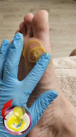 Foot Corn Making Every Step Uncomfortable! Give Your Feet Some Extra Care! 🦶✨
