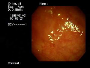 Moderate ulcerative proctosigmoiditis