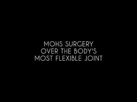 Sports Mohs Specialist Dr. Salar Hazany performs reconstruction of shoulder skin