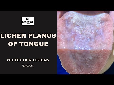 How to take care of Tongue Lichen Planus. White, slightly raised lesions like a moss over tongue.