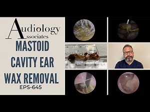 MASTOID CAVITY EAR WAX REMOVAL - EP645