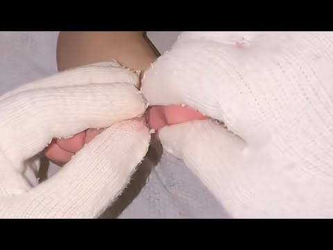 Use specialized gloves for athlete's foot to scratch it（32）【Athlete’s foot pedicure】