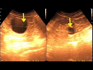 Three cases of renal Cortical Cyst | Kidney Cyst