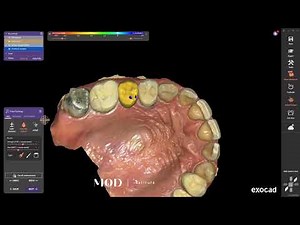 Split file 3D printed partial denture exocad design