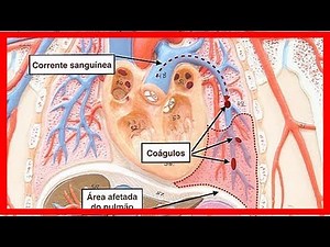 Behandlung für Lungenembolie