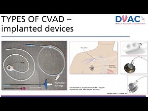 Paediatric Central Vascular Access Devices: Difficult Vascular Access in Children (DVAC)