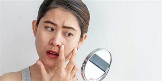 Think You Might Have Stress Acne? Here’s How to Treat It Fast