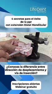 En el modelo ya se ha preparado la superficie y estamos marcando dos conceptos clave para el diseño correcto de una prótesis parcial removible: ⚫ Dirección de desplazamiento → indicada por la flecha negra: señala la salida vertical oclusal de la prótesis. 🔴 Vía de inserción y remoción → representada por el vector rojo de doble sentido: es el eje en el que se coloca y retira la prótesis. ⚠️ Aunque muchos los confunden, no son lo mismo. 👉 En este caso, la prótesis se inserta desde posterior haci