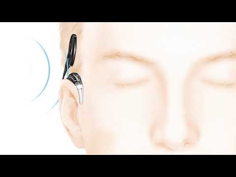 How the Cochlear™ Nucleus® implant system works