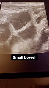 4.4K views · 268 reactions | Small bowel infection | Ultrasound made easy | Facebook