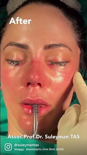 Rhinoplasty & Face Lift & Nano Fat Injection | Before And After