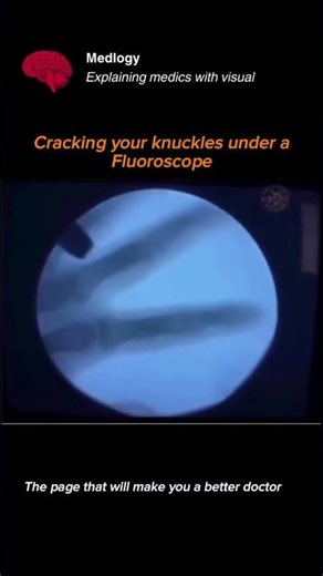 💥 Cracking Your Knuckles — Explained Under a Fluoroscope! 🦴✨