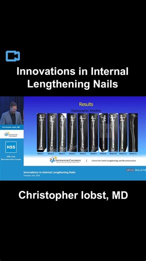 Orthobullets on Instagram: "New expert video by Christopher Iobst, MD of @NationWideKids at the 2024 @HSpecialSurgery Limb Reconstruction Course. Click the link in bio to watch this and related videos on Orthobullets."