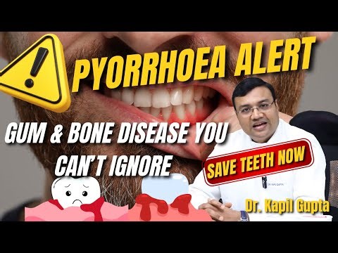 Pyorrhoea: Causes, Stages & Treatment | DR. KAPIL GUPTA