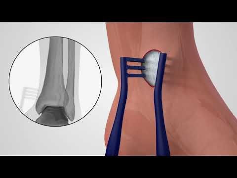 ANTHEM® Distal Tibia Fracture System