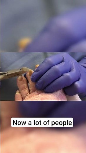 Diabetes and Nail Care Importance