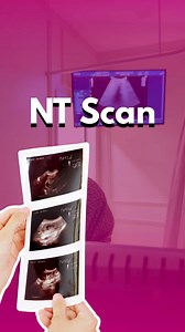 퐀퐏퐀 퐈퐓퐔 퐍퐓 퐒퐂퐀퐍 ? • NT Scan atau Nuchal Translucency Scan ialah...