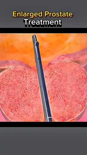 4.9K views · 37 reactions | enlarged prostate treatment #ProstateHealthMatters #KnowYourProstate #MensHealthAwareness #ProstateCare #HealthyProstateJourney #StopProstateProblems #ProstateEnlargementAwareness #TakeCareDownThere #MensWellnessTalk #ProstateWellness #fyp | Surgery Page | Facebook