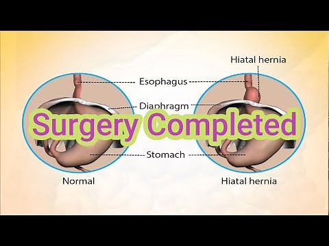 My Experience with Hiatal Hernia Repair and Nissan Fundoplication