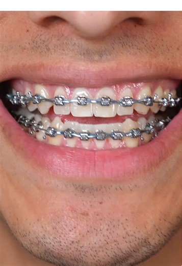 This is how I keep my teeth clean! 😁 #braces #bracestips #bracesoff #fyp #viral #food #candy #bracescolors #transformation #sour