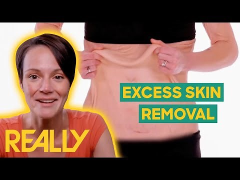Woman Undergoes Surgery To Remove Excess Skin After 200-lb Weight Loss | My Extreme Excess Skin